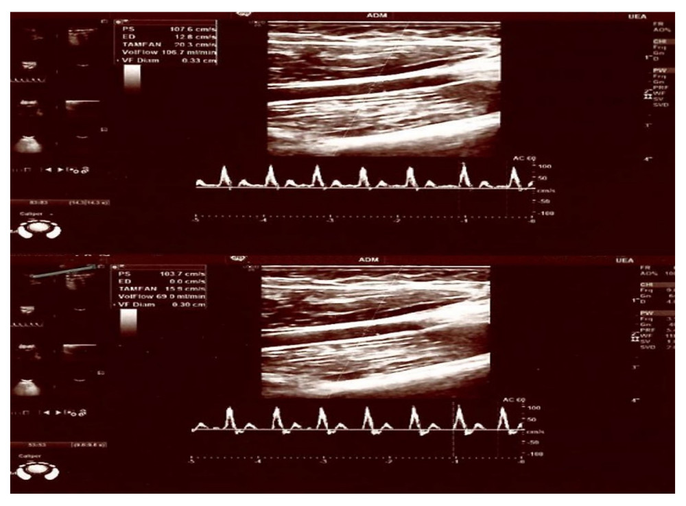 A 27-year-old male healthy volunteer with a pre-stimulation flow/diameter of 106.3 mL/min, 0.33 cm and post-stimulus flow/diameter of 69 mL/min, 0.30 cm.
