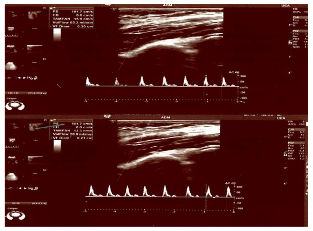 A 22-year-old female healthy volunteer with a pre-stimulation flow/diameter of 81.9 mL/min, 0.35 cm and post-stimulus flow/diameter of 55 mL/min, 0.30 cm.