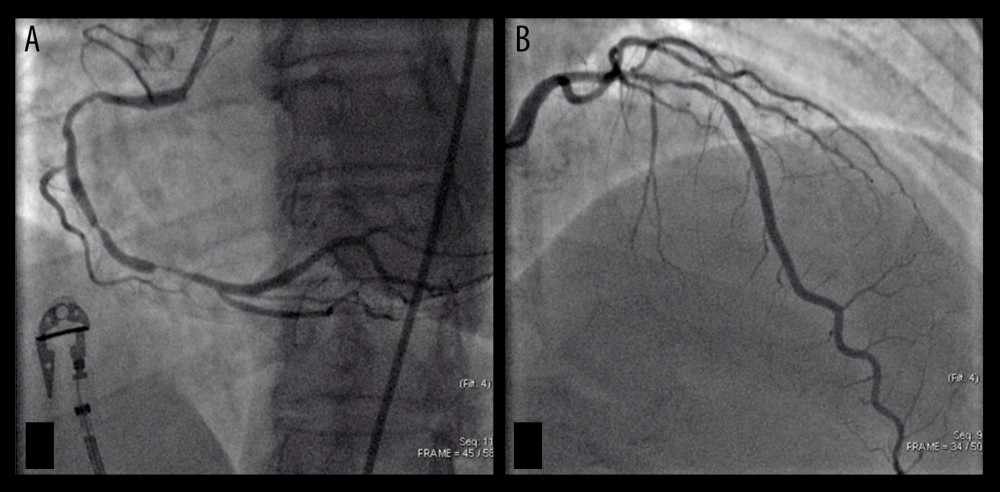 Subtotal occlusion of the right coronary artery (A) – infarct-related artery or culprit vessel. Non-culprit lesion on the left anterior descending artery (B). Both angiograms were performed during index PCI procedure.