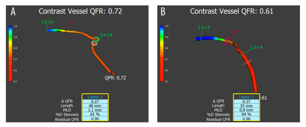 Functionally significant stenosis on the left anterior descending artery. (A) QFR evaluation during the index PCI procedure. (B) QFR evaluation was performed 3 months and 14 days after index PCI (through the staged PCI procedure). The case showed the highest difference between QFR 1 and QFR 2 values in our study. However, it did not change the clinical treatment decision.