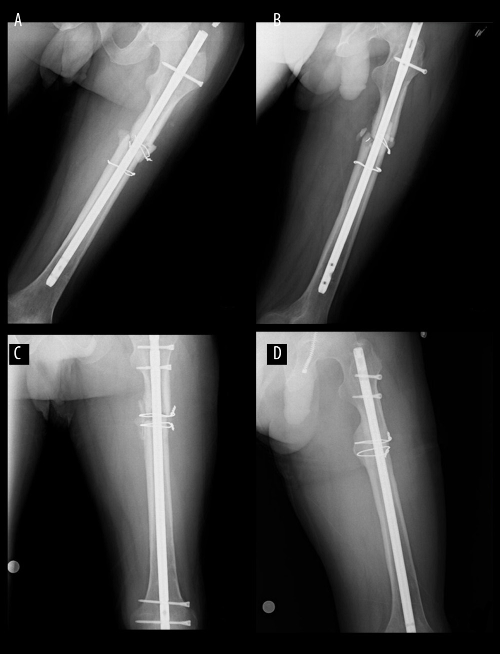 45-year-old male tibial fracture A) postoperative 8th month radiography B) postoperative 8th month radiography C) Decortication – Bone Grafting Method application postoperative radiograph D) postoperative 18th month after decortication – Bone Grafting application radiograph.