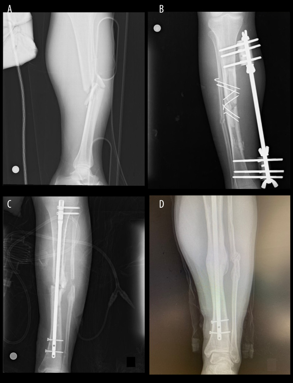 43-year-old male femur fracture A) fracture radiography B) postoperative 11th month radiography C) Decortication – Bone Grafting Method application postoperative radiograph D) postoperative 14th month after decortication – Bone Grafting application radiograph.