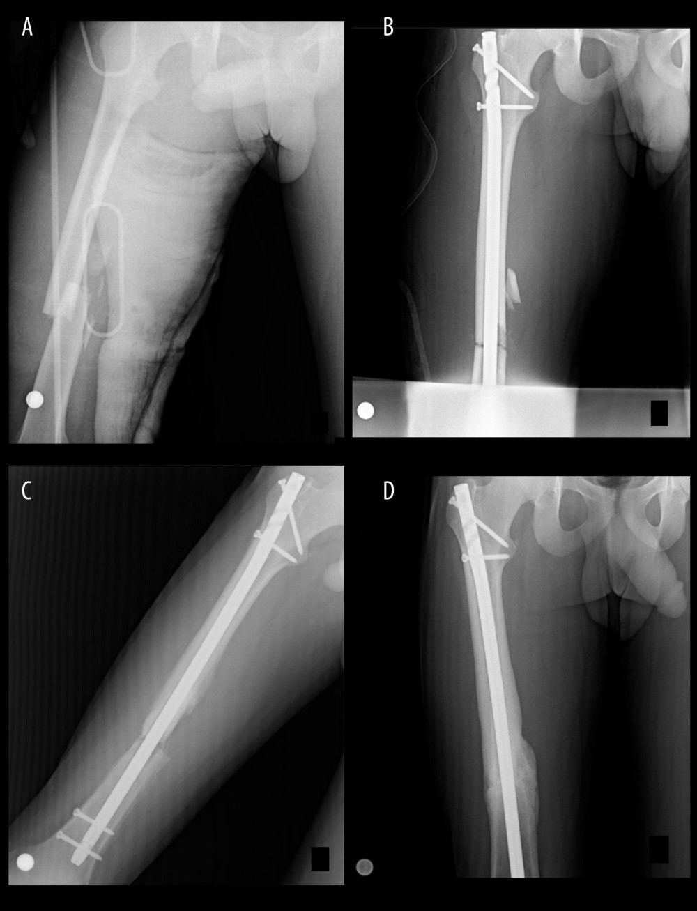21-year-old male femur fracture A) fracture radiography B) post-operative radiography C) post operative 12th month radiographic ESWT applied D) post-operative 18th month after ESWT application radiograph.