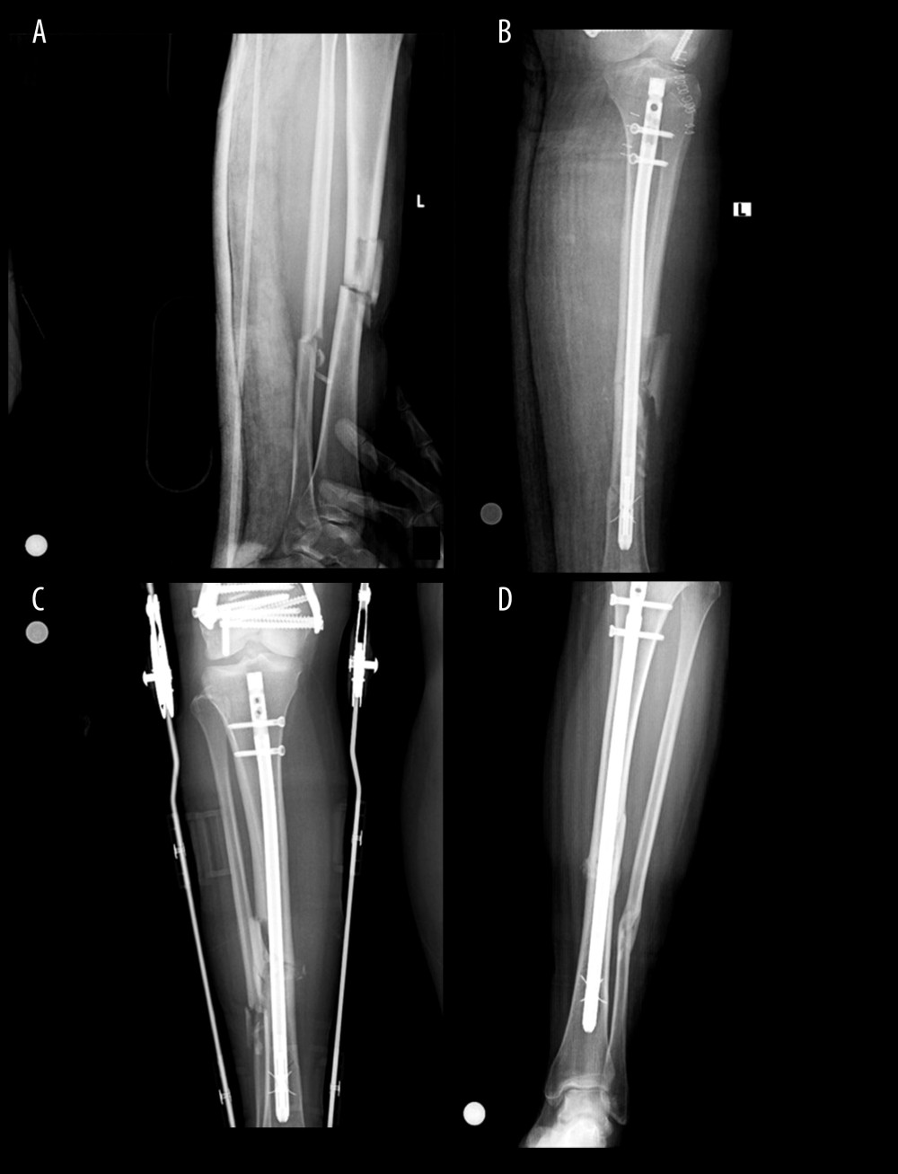 30-year-old male tibial fracture A) fracture radiography B) postoperative radiography C) post operative 10th month radiographic ESWT applied D) post-operative 22th month after ESWT application radiograph.