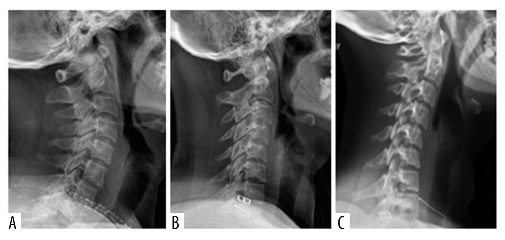 (A) Normal cervical lordosis. (B) Loss of cervical lordosis. (C) Cervical kyphosis.