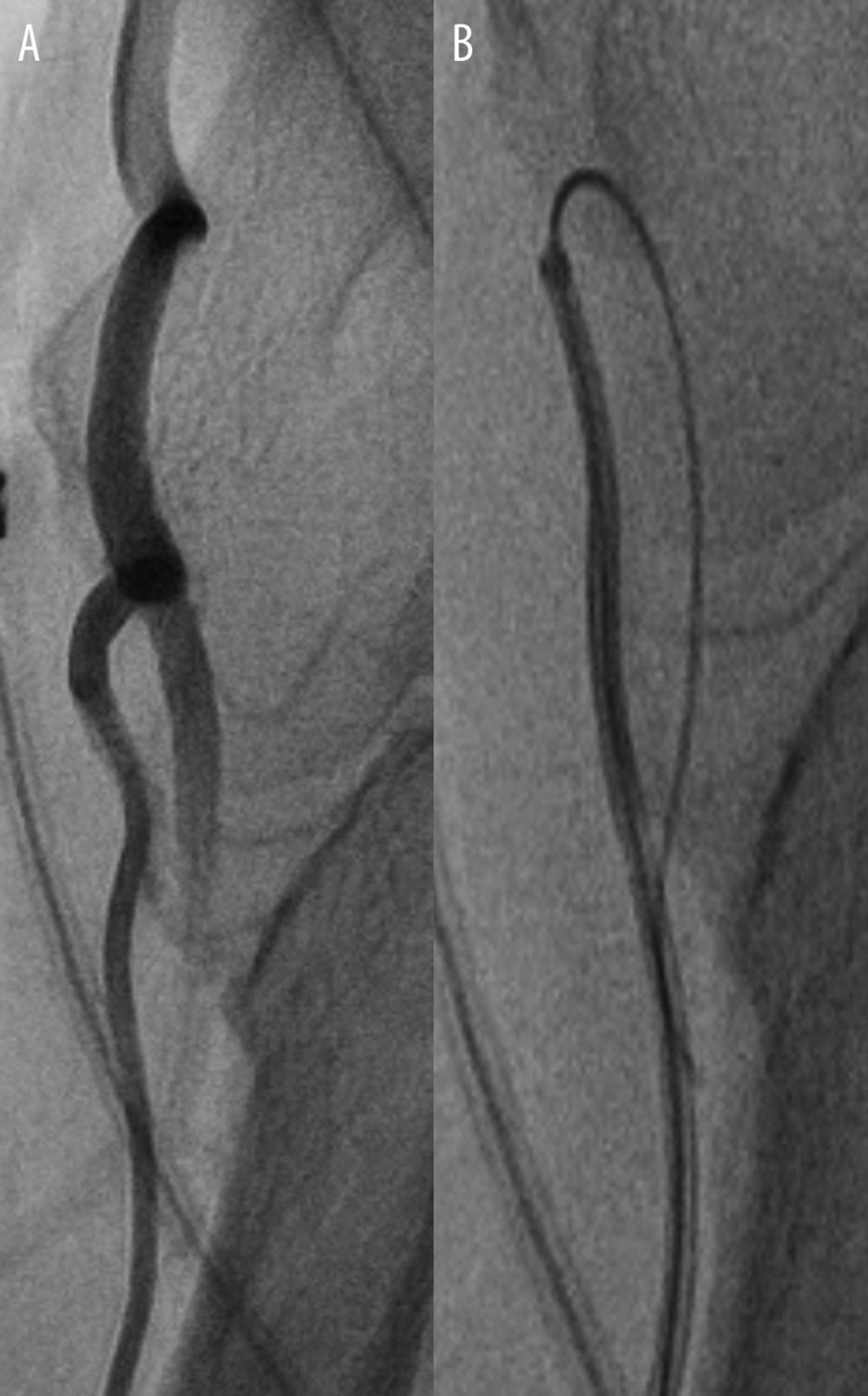 A case of tortuosity in the radial artery which could not be passed with the standard J-tip guidewire (A). The Radifocus wire had low steerability and torque transmission; therefore, it always chose the distal path (B). The Silverway wire was able to cross the tortuosity and reached the aortic valve in 19 seconds (no image available).