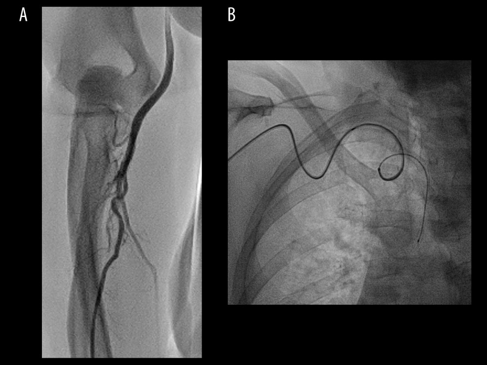 Tortuosity at radial artery level (A) and subclavian/brachiocephalic level (B) in 1 patient. The Silverway wire was able to cross both anomalies and deliver the catheter to the aortic valve in 127 seconds.