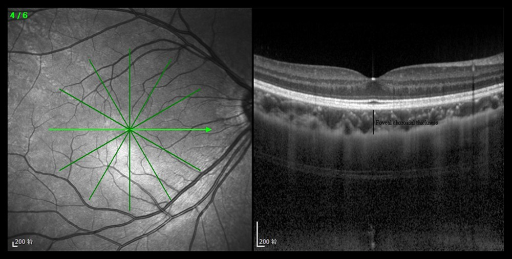 The measurement of foveal choroidal thickness (the black line).