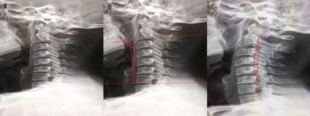 Regular position. (A) A retroflexion of cervical vertebra was observed. (B) Before treatment, the C2–7 Cobb angle was −11.5°, and the D value was obviously negative. (C) After 12 months’ treatment, the D value was 0.5 mm, which was significantly improved from the previous negative value.