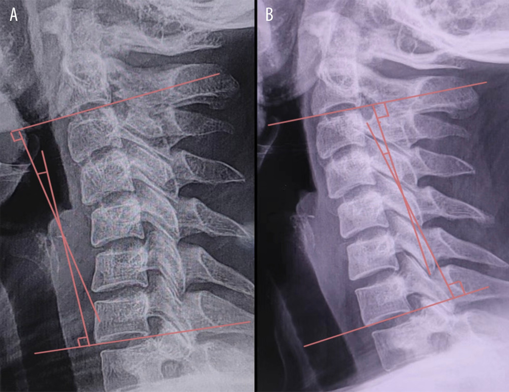 Natural position. (A) Before treatment, a retroflexion of cervical vertebra was observed. The C2–7 Cobb angle was −13.5°. (B) After treatment, significant improvement of cervical physiological curvature was observed. The C2–7 Cobb angle was 12°.