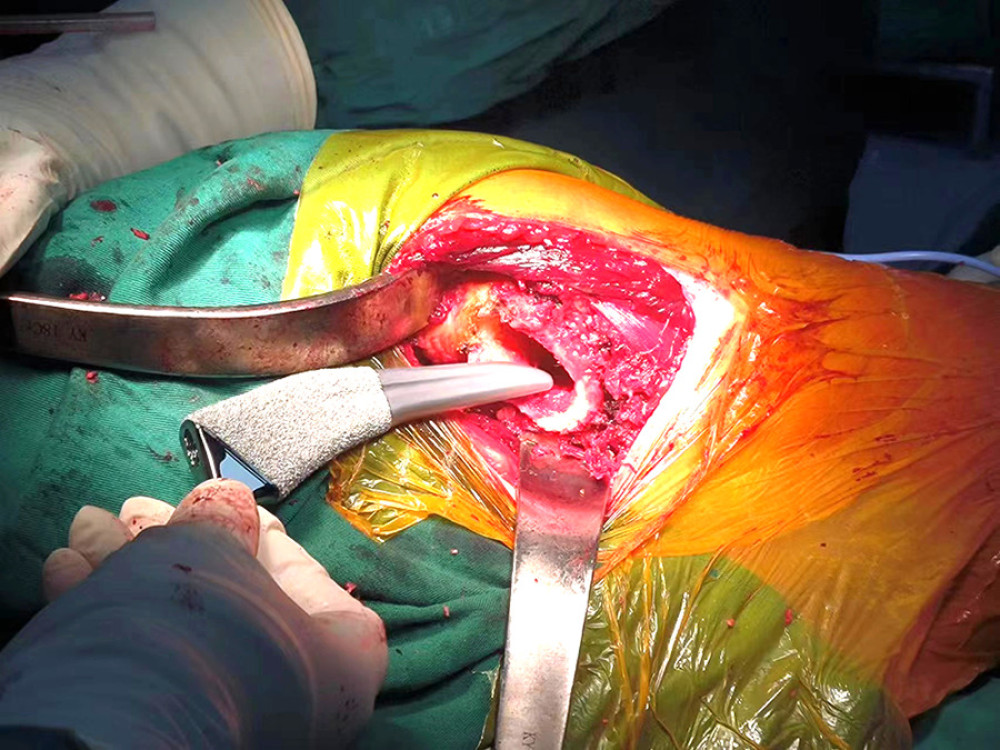 Process of Tri-lock femoral stem prosthesis implantation via DAA.