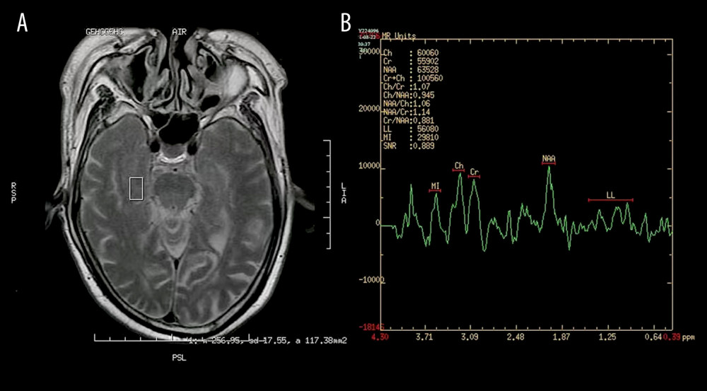 Images of magnetic resonance spectroscopy. (A) Region of interest (ROC); (B) right hippocampus 1H-MRS.