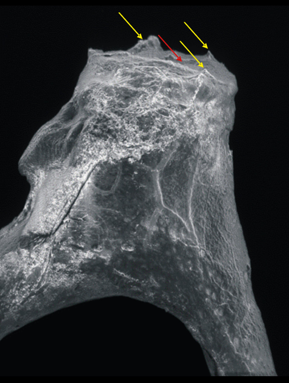 Otosclerosis. The head of the stapes. Magnification 150×. LVSED (low vacuum secondary electron detector). Workshop of Scanning Microscopy. Damage to the surface of the bone tissue of the stapes head: osteophytes (yellow arrow) and irregularity of the structure of the articular surface (red arrow). Prepared using CorelDraw9, Corel Corporation.