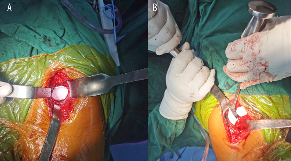 (A, B) Acetabular and femoral stem prostheses during DAA.