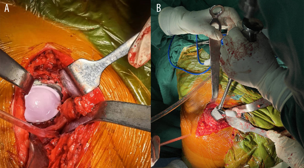 (A, B) Acetabular and femoral stem prosthesis during PLA.