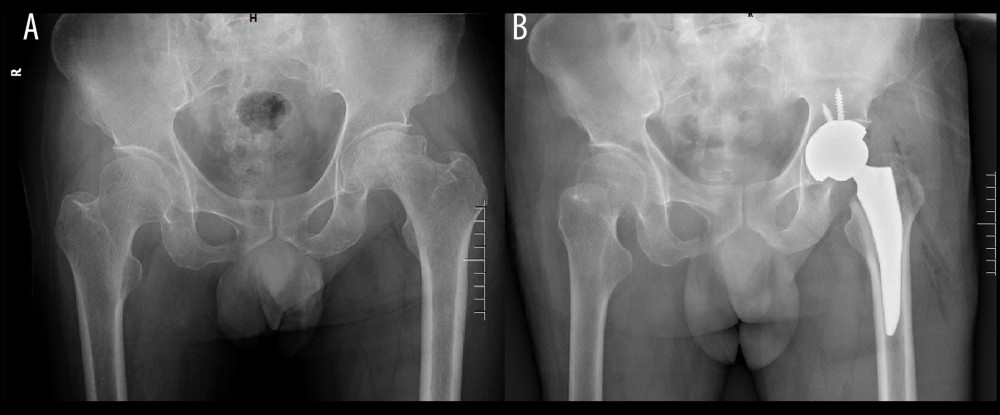 (A, B) Preoperative and postoperative anteroposterior X-rays of patients with DAA.