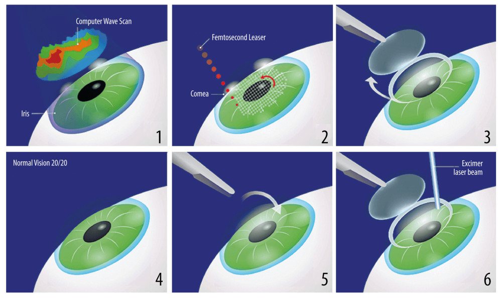 Stages of the deep anterior lamellar keratoplasty (DALK) surgical procedure. (1) Hesburg-Baron vacuum trepan applied to the center of the cornea; (2) cornea incised to a depth of 80% of the corneal dermis; (3) 27G needle bent at a 30° angle before insertion into the corneal dermis; (4) corneal dermis dissected with air; (5) Descemet’s membrane dissected; (6) patient’s eye after completed anterior layered corneal transplantation.