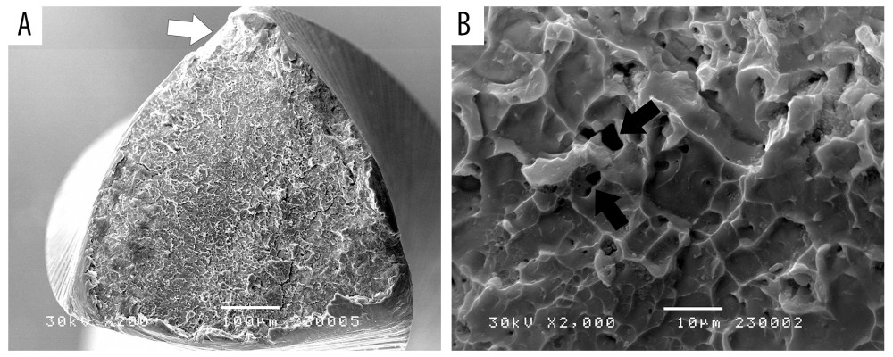 Scanning electron microscopy (SEM) of the fractured fragment of the ProTaper Universal. (A) Initial crack on the periphery of the fragment section (white arrow) (×200). (B) Pliant pattern of the fractured surface with pits (black arrows) (×2000). Image Software: Adobe Photoshop, CS6, Adobe Systems.