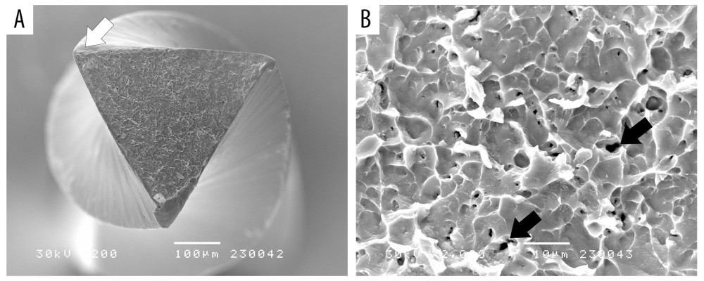 Scanning electron microscopy (SEM) of the fractured fragment of the BioRace. (A) Disruption of the cutting edge (white arrow) (×200). (B) Ductile surface of the fractured fragment with pits and cracks (black arrows) (×2000). Image Software: Adobe Photoshop, CS6, Adobe Systems.