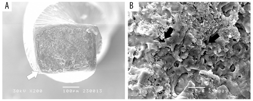 Scanning electron microscopy (SEM) of the fractured fragment of the ProTaper Next. (A) Crack initiations on the periphery of the fractured surface (white arrow) (×200). (B) Depression features characteristic of ductile failure (black arrows) (×2000). Image Software: Adobe Photoshop, CS6, Adobe Systems.