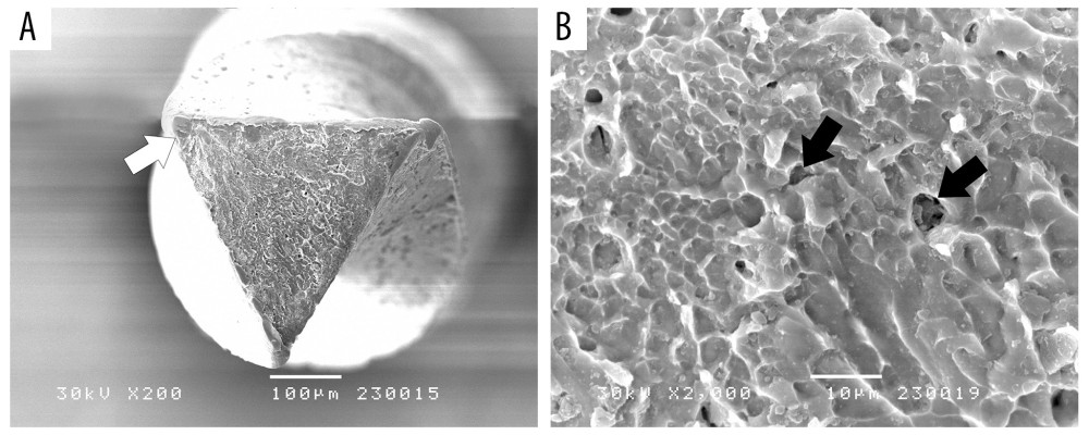 Scanning electron microscopy (SEM) of the fractured fragment of the Twisted File. (A) Fatigue crack propagation on the cutting edge (white arrow) (×200). (B) Pliable pattern of the surface with microvoids (black arrows) (×2000). Image Software: Adobe Photoshop, CS6, Adobe Systems.