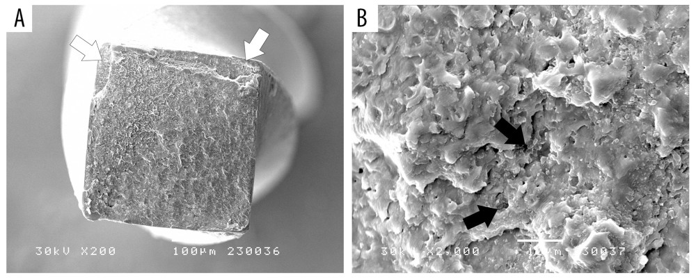 Scanning electron microscopy (SEM) of the fractured fragment of the HyFlex CM. (A) Signs of initial fracture (white arrows) (×200). (B) Surface with signs of initial fatigue, cracks, and pits (black arrows) (×2000). Image Software: Adobe Photoshop, CS6, Adobe Systems.
