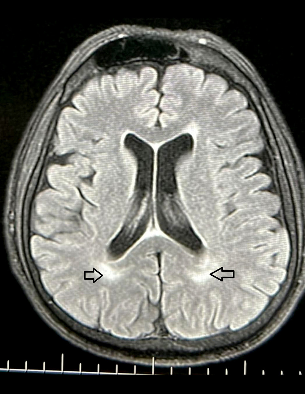Axial section of periventricular white matter lesions in a T2 weighted magnetic resonance image. The lesions in cerebral white matter are shown (arrows) in a patient with House-Brackmann grade 5 Bell’s palsy. This figure was created using PowerPoint 2013 (Microsoft).
