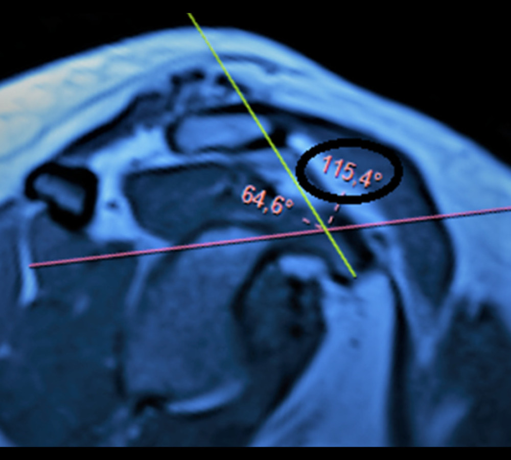 Coracoid angle. It is measured as the angle between the long axes of the proximal and distal segments of the coracoid process in a T1-weighted oblique sagittal magnetic resonance imaging section (circle). (Fonet Dicom Viewer, v4.1, Fonet Bilgi Teknolojileri A.Ş., Gölbaşı, Ankara, TR).