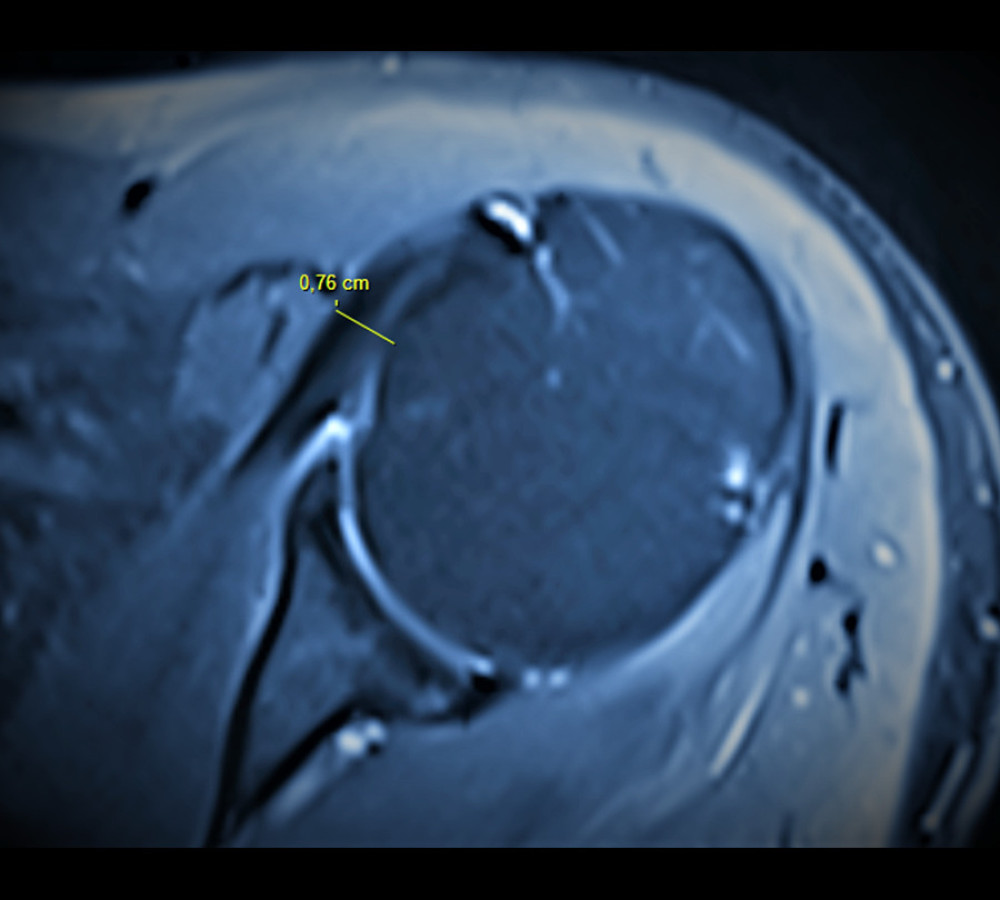 Coraco-humeral distance. It is measured as the shortest distance between the coracoid process and the tuberculum minus (axial T2-weighted magnetic resonance imaging section). (Fonet Dicom Viewer, v4.1, Fonet Bilgi Teknolojileri A.Ş., Gölbaşı, Ankara, TR).