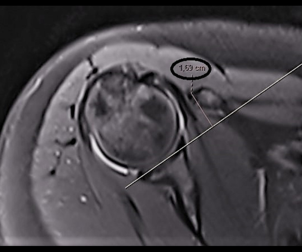 Coracoid overlap. The distance between the most distal part of the coracoid process and the glenoid is measured (circle; axial T2-weighted magnetic resonance imaging section). (Fonet Dicom Viewer, v4.1, Fonet Bilgi Teknolojileri A.Ş., Gölbaşı, Ankara, TR).CHD – coraco-humeral distance; CHA – coracohumeral angle; CGA – coraco-glenoid angle; CO – coracoid overlap; CBGA – coracoid-body glenoid angle; CTGA – coracoid tip-glenoid angle; CTBA – coracoid tip-body angle; LTA – lesser tuberosity angle; LTH – lesser tuberosity height; CSA – coraco-scapular angle; CA – coracoid angle; CI – confidence interval; agr – agreement.
