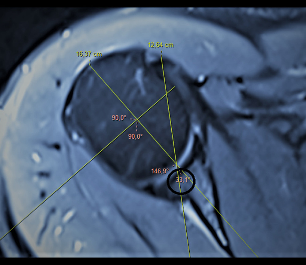 Lesser tuberosity angle. The angle between the vertical line that equally divides the line connecting the anterior and posterior cartilage of the humeral head and the most prominent part of the lesser tuberosity is measured (circle; axial T2-weighted magnetic resonance imaging section). (Fonet Dicom Viewer, v4.1, Fonet Bilgi Teknolojileri A.Ş., Gölbaşı, Ankara, TR).