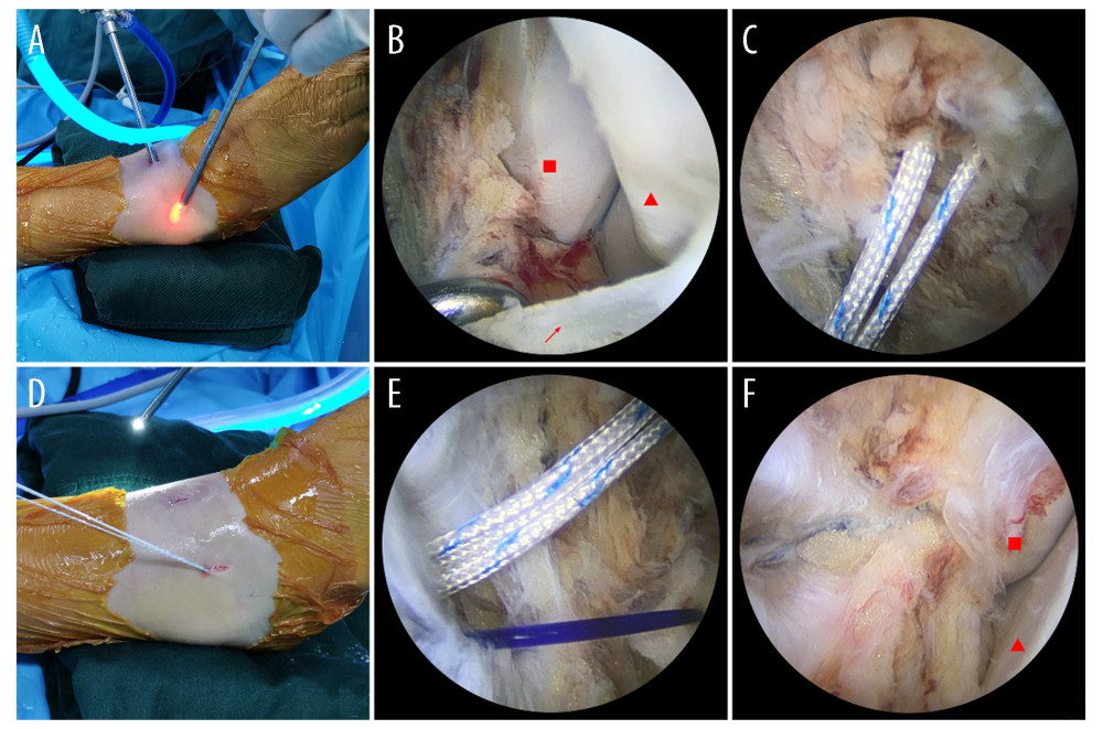 (A) Standard anterolateral and anteromedial ankle arthroscopic approaches were established. (B) Use the probe hooks to detect ATFL (red arrow) damage ( fibula, Talus). (C). The double suture anchor was inserted into the middle of the fibula footprint area. (D) Confirm the pull-out resistance of the anchor by pulling the anchor wire. (E) Use nylon wire to guide the anchor wire through the ATFL. (F) Confirm the effectiveness of the suture under the arthroscopic visualization and check the stability of the ankle ( fibula, Talus). All figures were created using PS (Adobe Photoshop CC, Adobe Systems, California, USA).
