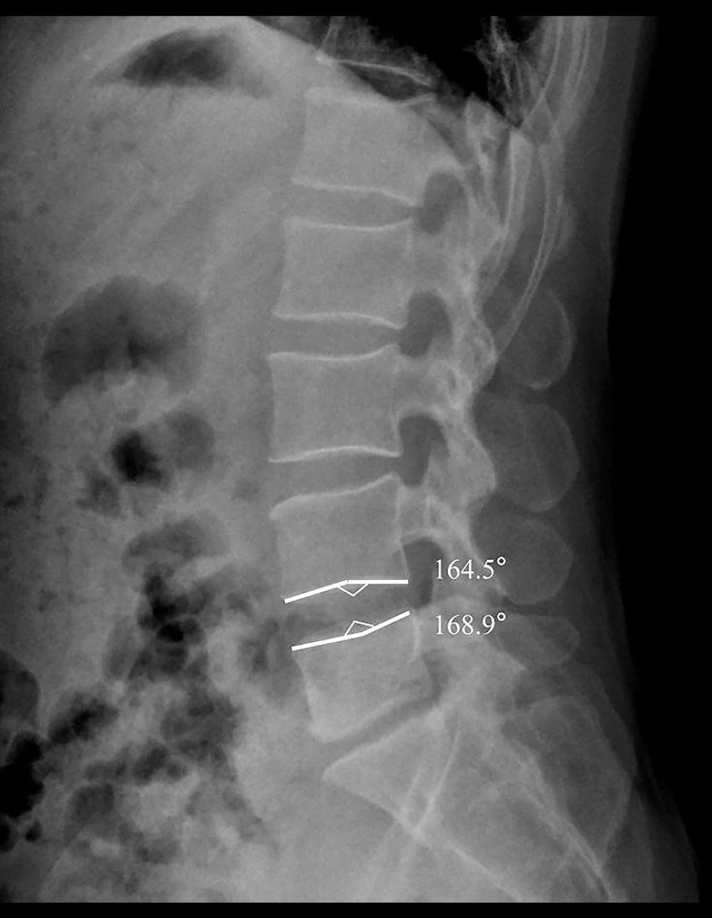 Measurement of the ECA: On the sagittal X-ray of the lumbar spine, the bone endplate of lumbar vertebra is in arc shape, and a line was drawn from the summit/bottom of arc along to the endpoints, and the angle between these 2 lines is defined as the ECA.
