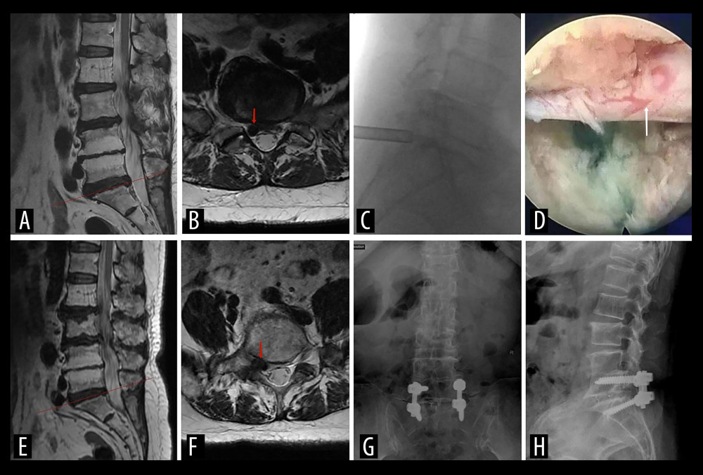 (A, B) Preoperative MRI scan shows the segment of lumbar disc herniation at L5-S1 (red arrow). (C) The working channels of interlaminar approach. (D) The decompressed nerve root under endoscopic view (white arrow). (F, F) Three years later, MRI reexamination showed the herniated disc on the right side at level L5-S1 with severely foraminal stenosis (red arrow). (G, H) X-ray examination of lumbar vertebrae after reoperation.