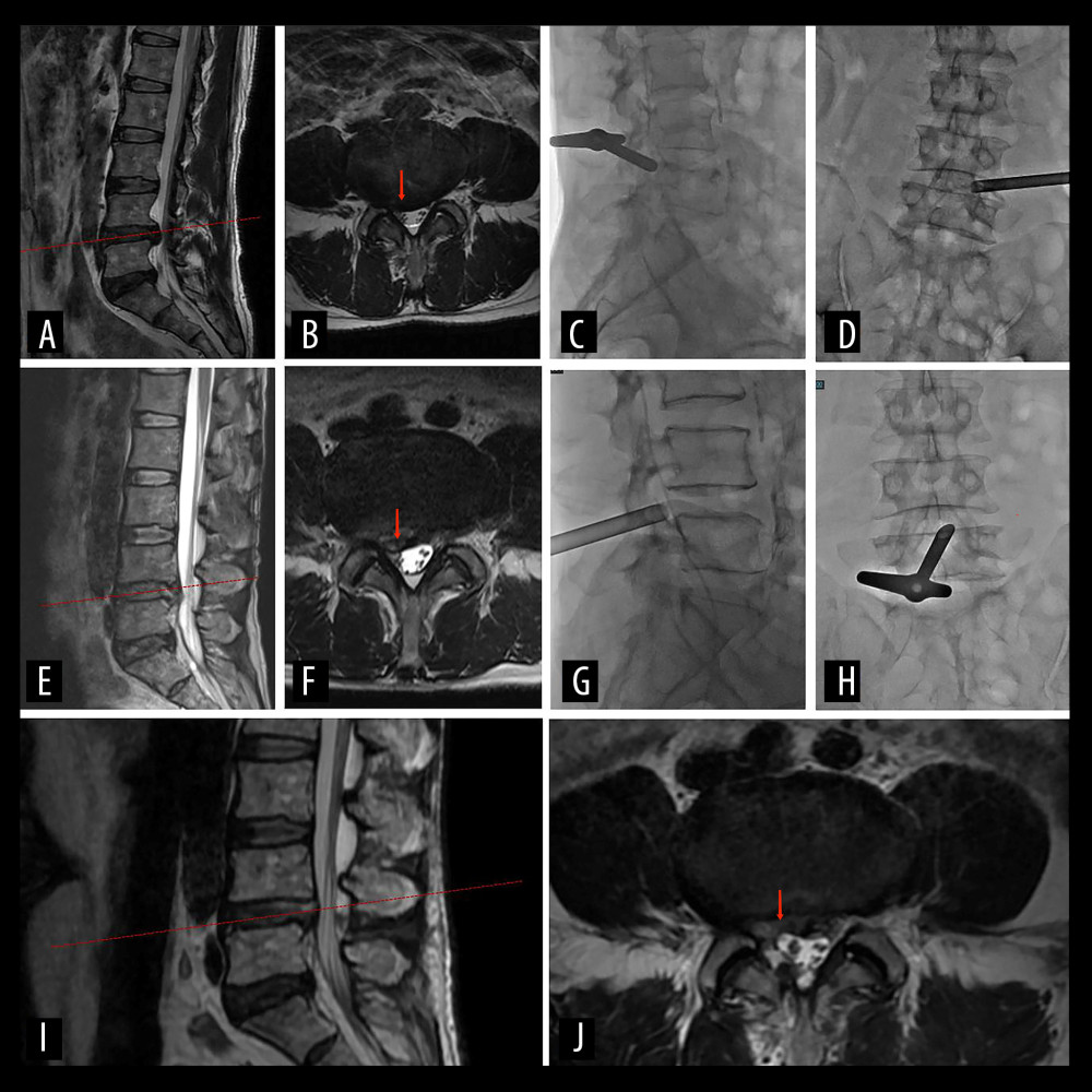 A 57-year-old man with severe right leg radiating pain for 6 months. (A, B) Preoperative MRI scan shows the segment of lumbar disc herniation at L4–L5 (red arrow). (C, D) The working channels of transforaminal approach during the first PELD. (E, F) MRI reexamination at 1 month after the first PELD. The red arrow indicates residual intervertebral disc tissue. (G, H) The working channels of interlaminar approach. (I, J) MRI reexamination showed the dural sac was well-filled and there was no compression of nerve roots after reoperation (red arrow).