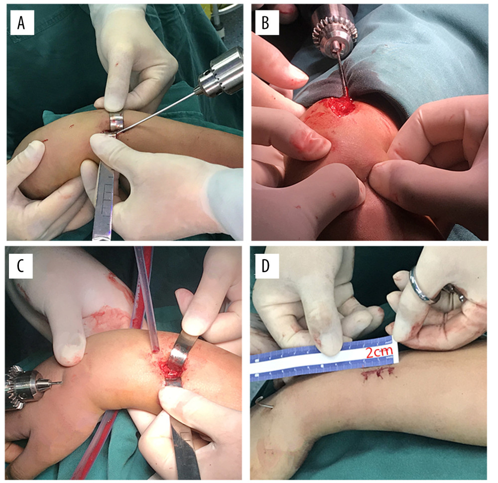 (A–D) Intraoperative procedures(A) The dorsal longitudinal incision was made to expose the fracture end. (B) The smooth Kirschner wire was inserted antegradely from the fracture end into the medullary cavity of distal radius and 2 thumbs touched and pushed the tendons on both sides to avoid the Kirschner wire penetrating the tendon. (C) Under direct vision, reduction was performed and Kirschner wires were retrogradely inserted into the proximal radial medullary cavity. (D) The incision length was about 2 cm. This figure was created using WPS software (Windows version, 11.1.0., China).