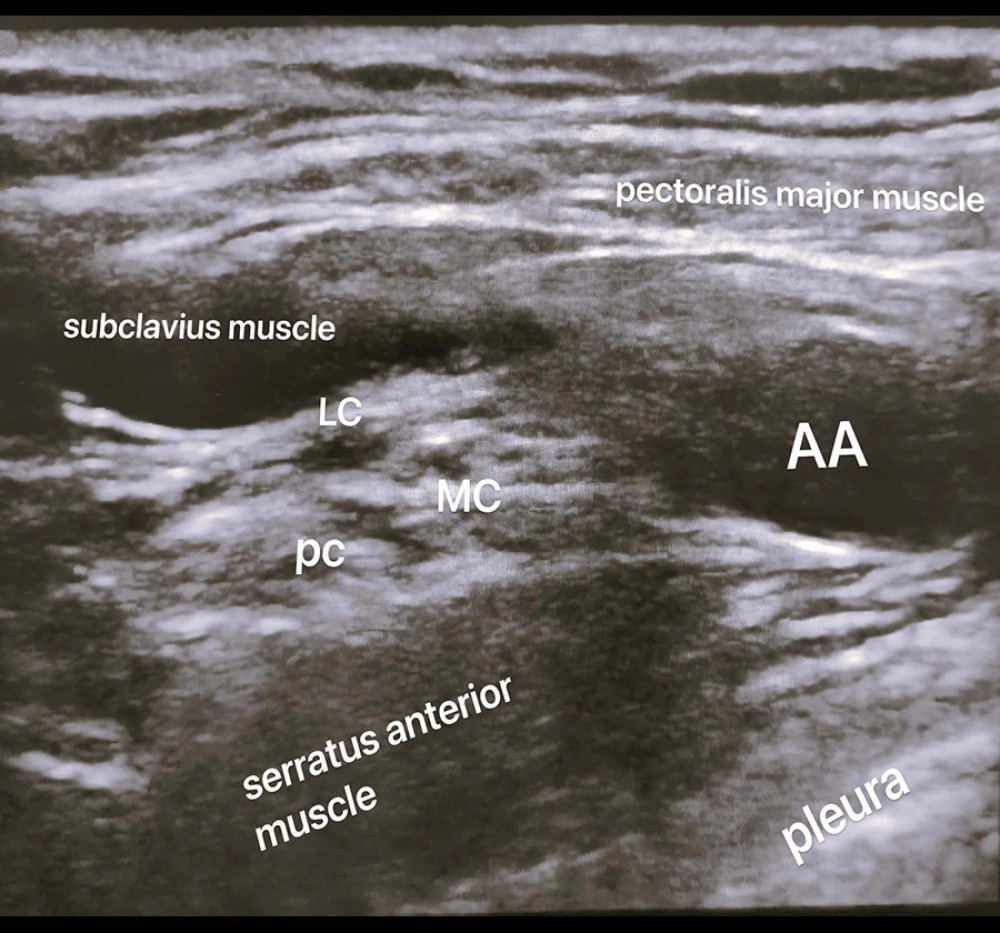 This image was created using the Sonosite SII ultrasound system provided by FUJIFILM Sonosite. AA – axillary artery; LC – lateral cord; PC – posterior cord; MC – medial cord.