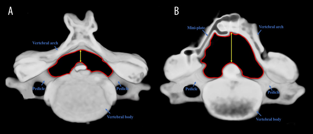 Three-dimensional reconstruction of a patient’s cervical spine(A) Preoperative; (B) Postoperative. Red lines represent the measurement of cross-sectional area, yellow lines represent the measurement of sagittal canal diameter.