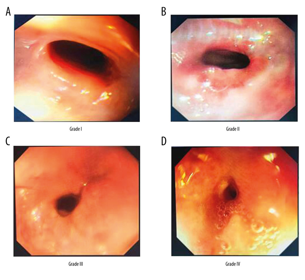 (A–D) Stooler classification under endoscope in post-endoscopic submucosal dissection esophageal stricture of early esophageal cancer (grade I–IV).