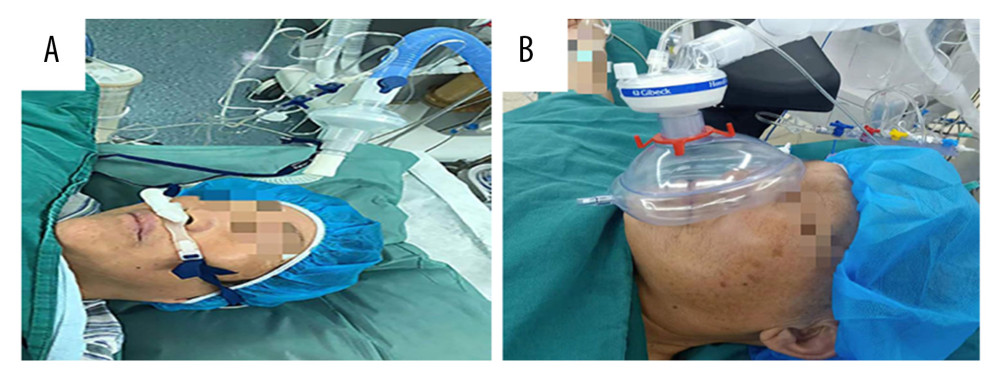(A) The use of transnasal humidified rapid-insufflation ventilatory exchange. (B) The use of facemask. This figure was created using Office Word (version 16.16.27 by Microsoft).