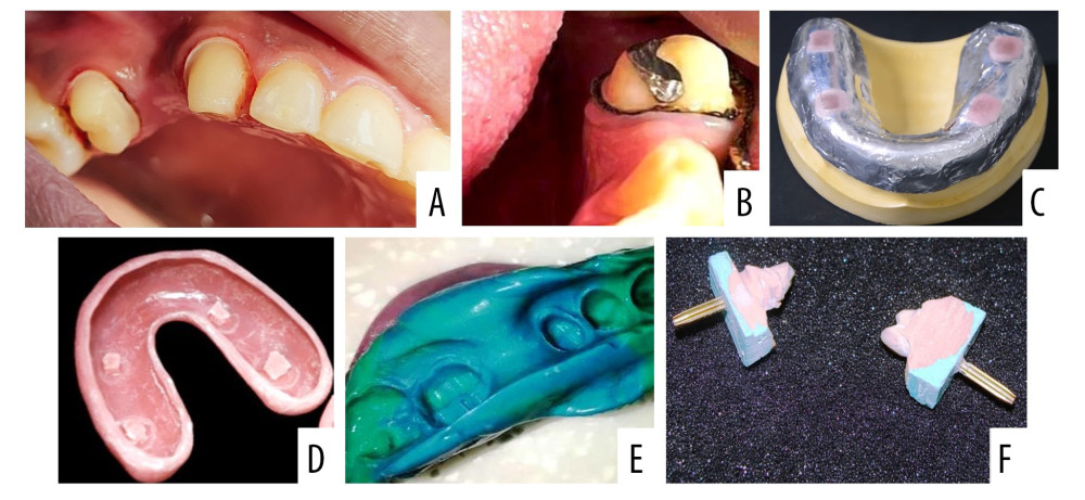 Sequence of clinical procedures during and after gingival retraction. (A) Gingival retraction of maxillary left canine and second premolar using cotton retraction cord. (B) Gingival retraction of a mandibular left canine and second premolar tooth using polymer retraction cord. (C) Special/custom tray fabrication showing an adapted 2 thickness modelling wax sheet with vertical stops covered with light cure resin. (D) Special tray after removal of wax spacer. (E) Definitive impression of the prepared teeth that was intended to receive a 3 unit fixed partial denture. (F) Individual dies used for fabrication of the crown and testing the sulcus depth. Photographs taken using a digital single-lens reflex (DSLR) camera (Canon EOS 700D) with 100 mm macro lens) with/without ring flash. Figure created using MS PowerPoint, version 20H2 (OS build 19042,1466), windows 11 Pro, Microsoft corporation).