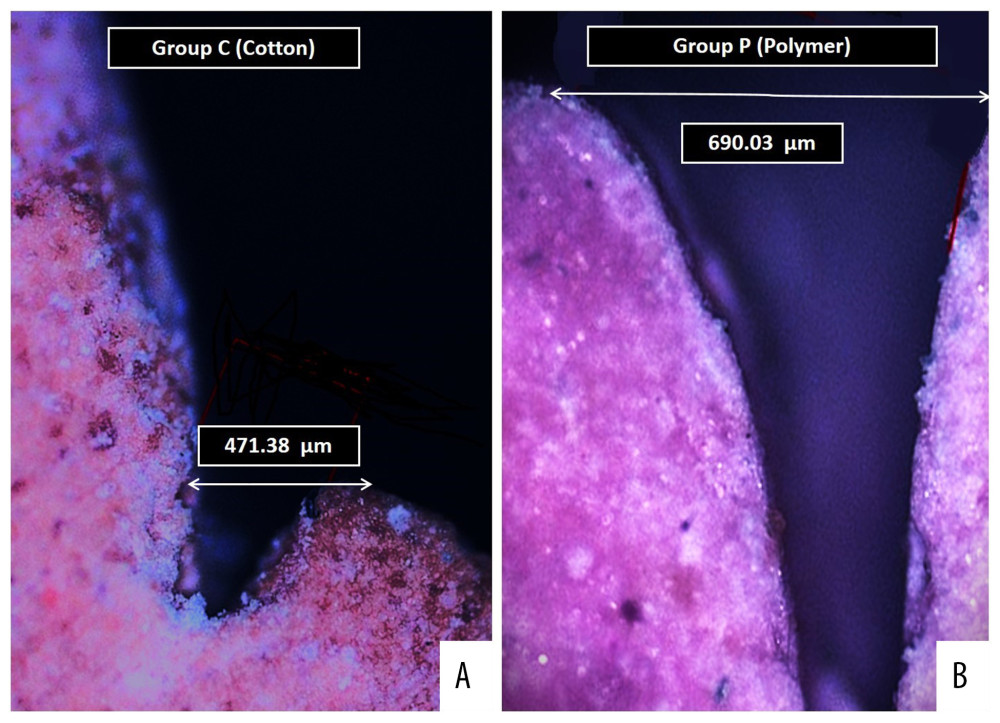 Digital images of the die cast observed under optical microscope showing (A) Measured sulcus width between the 2 points as perpendicular distance from the maximum height of the stone cast gingival margin on one side and tooth surface on other side for specimens in group C. (B) Measured sulcus width between the 2 same points for specimens in group P. Photographs were taken using a digital single-lens reflex (DSLR) camera (Canon EOS 700D) with 100 mm macro lens) with/without ring flash.