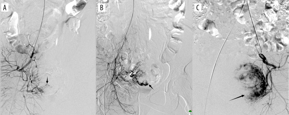 (A) Digital subtraction angiography imaging showing sparse gestational sac staining (black arrow); (B) general gestational sac staining (black arrow); (C) obvious gestational sac staining (black arrow). The figure was created with PowerPoint software (Microsoft 365 Office).