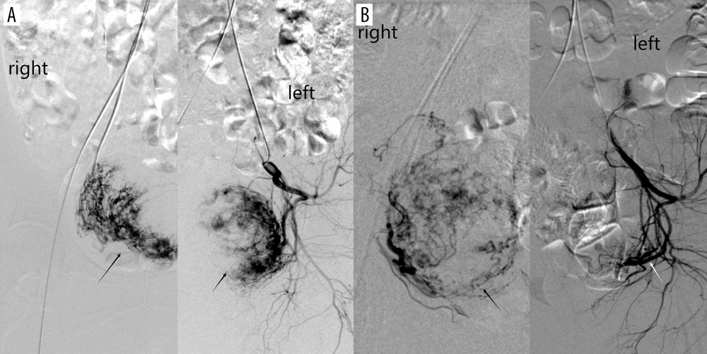(A) Digital subtraction angiography imaging showing bilateral uterine artery supply to the gestational sac (black arrow); (B) right uterine artery supply to the gestational sac (black arrow), with no gestational sac blood flow from the left uterine artery (white arrow). The figure was created with PowerPoint software (Microsoft 365 Office).