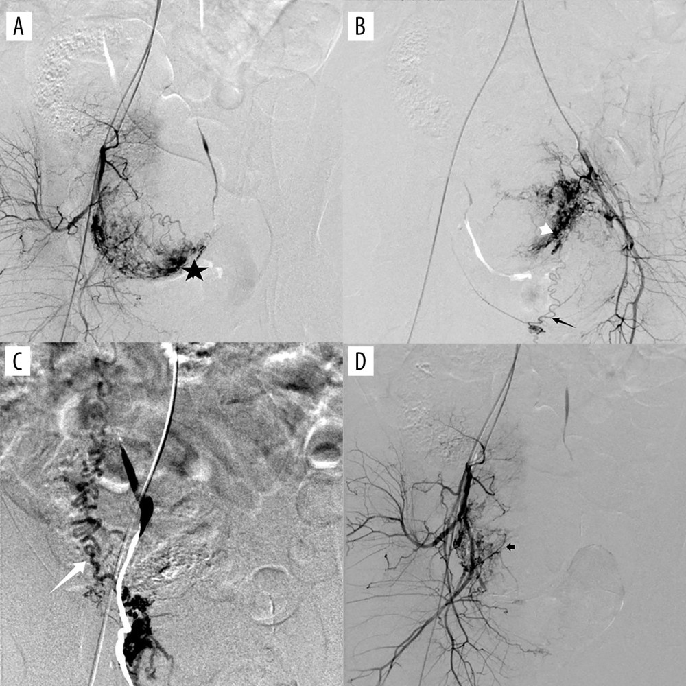 (A) Digital subtraction angiography imaging showing uterine artery (star) and multiple collateral blood supplies to the gestational sac; (B) superior vesicle arteries (white short arrow); (B) internal pudendal artery (black long arrow); (C) ovarian artery (white long arrow); and (D) other branches from the internal iliac artery (black short arrow). The figure was created with PowerPoint software (Microsoft 365 Office).