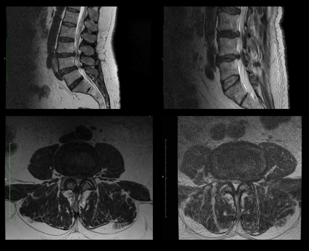 Sample MRI images of the lumbosacral spine of patients enrolled in the hemilaminectomy group, before surgical decompression.