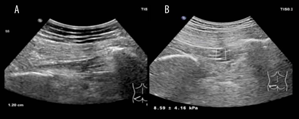Two-dimensional ultrasound images, thickness measurements, and ultrasonic shear wave elastography (SWE) use in controls(A) The measured value of piriformis muscle (PM) thickness on the left side of the control group was 12.0 mm. (B) The Young’s modulus value of the left PM of the control group was 8.59±4.16 kPa.
