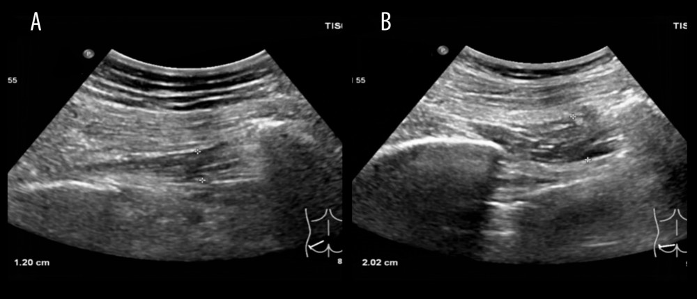 Two-dimensional ultrasonography thickness measurements in piriformis muscle(A) A female patient in the control group, 55 years old, having a thickness of the left piriformis muscle of 12.0 mm. (B) A patient in the observation group, a female, 53 years old, having a thickness of the left piriformis muscle of 20.2 mm.