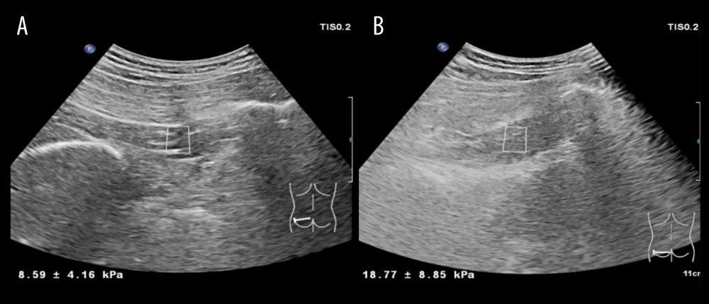 Use of ultrasonic shear wave elastography (SWE) measurement of piriformis muscle(A) In control group, a female, 55 years old, the Young’s modulus value of the left piriformis muscle was 8.59±4.16 kPa. (B) In observation group patient, a female, 53 years old, the Young’s modulus of the left piriformis muscle was 18.77±8.85 kPa.