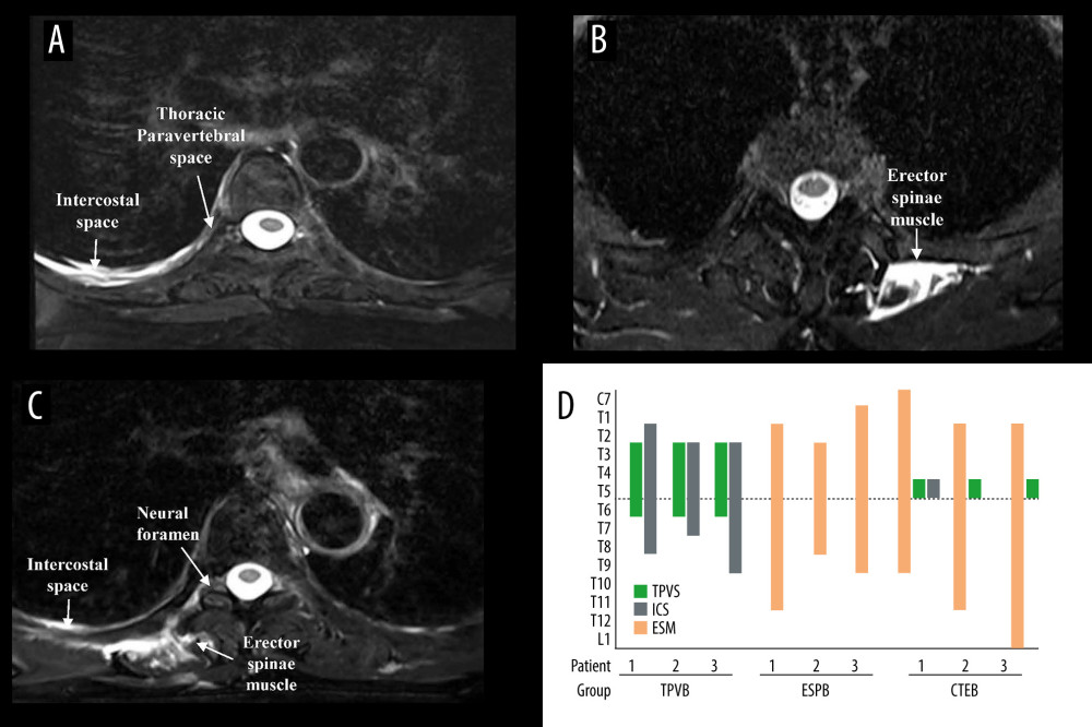 Axial MRI image of the spine showing the injectate spread after TPVB (A), ESPB (B), CTEB (C), and cranio-caudal spread of LA diffusion in the sagittal plane at intercostal space (ICS), thoracic paravertebral space (TPVS) and erector spinae muscle (ESM) in each patient (D). (A) Axial view of T5 vertebra, injectate dispersed into the ICS and TPVS in TPVB. (B) The injectate spread within the ESM in ESPB. (C) In CTEB, injectate was seen spreading to the ICS, the neural foramen, and the ESM at T5. (D) The LA distribution was mainly confined to the thoracic vertebral levels when patients received TPVB or ESPB. While the LA was detected from C7 to L1 in patients receiving CTEB. CTEB – combined thoracic paravertebral block and erector spinae plane block; ESPB – erector spinae plane block; LA – local anesthetic; TPVB – thoracic paravertebral block. (Microsoft PowerPoint 2019MSO, version 2303, Microsoft Corporation; Adobe Acrobat Pro DC, version 2015, Adobe Systems Inc.).